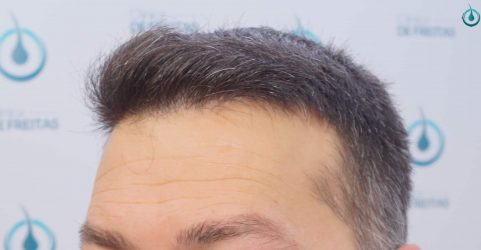 Injerto Capilar Frontal Coronilla Técnica FUE Grafts 4400 (11040 pelos) 40 43A RESULTADOS 2º CIRUGIA 12 MESES
