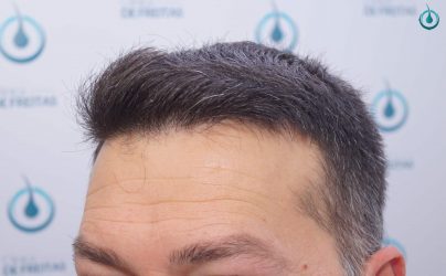 Injerto Capilar Frontal Coronilla Técnica FUE Grafts 4400 (11040 pelos) 41 43B RESULTADOS 2º CIRUGIA 12 MESES
