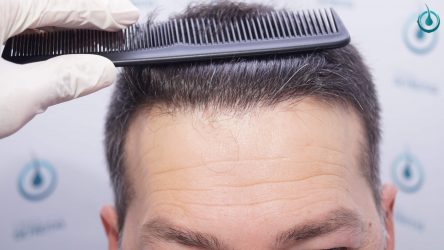 Injerto Capilar Frontal Coronilla Técnica FUE Grafts 4400 (11040 pelos) 42 44 RESULTADOS 2º CIRUGIA 12 MESES