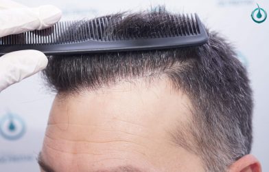 Injerto Capilar Frontal Coronilla Técnica FUE Grafts 4400 (11040 pelos) 43 46 RESULTADOS 2º CIRUGIA 12 MESES