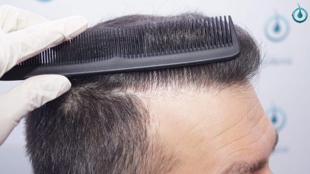 Injerto Capilar Frontal Coronilla Técnica FUE Grafts 4400 (11040 pelos) 44 47 RESULTADOS 2º CIRUGIA 12 MESES
