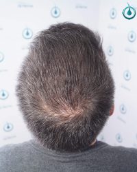 Injerto Capilar Frontal Coronilla Técnica FUE Grafts 4400 (11040 pelos) 45 48 RESULTADOS 2º CIRUGIA 12 MESES