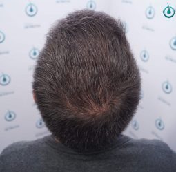 Injerto Capilar Frontal Coronilla Técnica FUE Grafts 4400 (11040 pelos) 46 49 RESULTADOS 2º CIRUGIA 12 MESES
