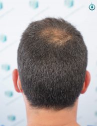 Injerto Capilar Frontal Coronilla Técnica FUE Grafts 4400 (11040 pelos) 4 5 ANTES DEL TRASPLANTE CAPILAR