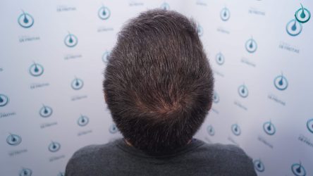 Injerto Capilar Frontal Coronilla Técnica FUE Grafts 4400 (11040 pelos) 47 50 RESULTADOS 2º CIRUGIA 12 MESES