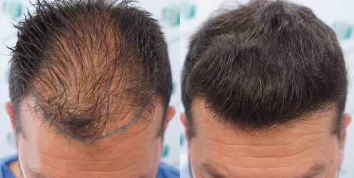 Injerto Capilar Frontal Coronilla Técnica FUE Grafts 4400 (11040 pelos) 48 52 COMPARATIVA