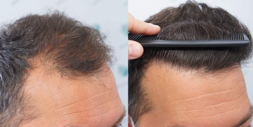 Injerto Capilar Frontal Coronilla Técnica FUE Grafts 4400 (11040 pelos) 49 53 COMPARATIVA