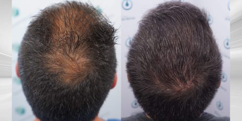 Injerto Capilar Frontal Coronilla Técnica FUE Grafts 4400 (11040 pelos) 51 55 COMPARATIVA