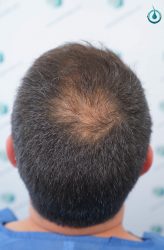 Injerto Capilar Frontal Coronilla Técnica FUE Grafts 4400 (11040 pelos) 5 6 ANTES DEL TRASPLANTE CAPILAR