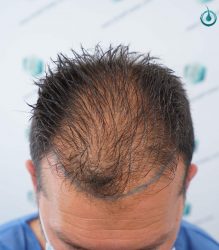 Injerto Capilar Frontal Coronilla Técnica FUE Grafts 4400 (11040 pelos) 6 8 DISEÑO LINEA INJERTO