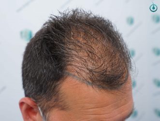 Injerto Capilar Frontal Coronilla Técnica FUE Grafts 4400 (11040 pelos) 7 9 DISEÑO LINEA INJERTO
